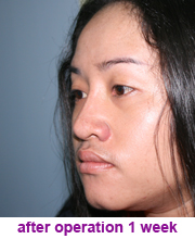 plastic_surgery_augmentation_rhinoplasty